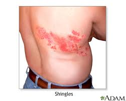 shingles